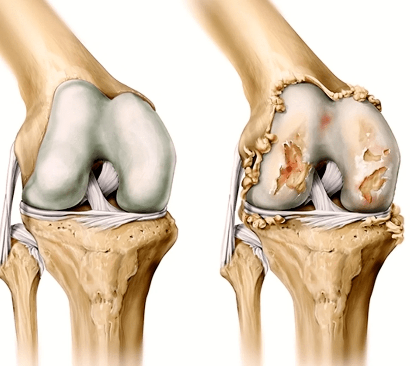 Healthy joints after using Artovitel gel