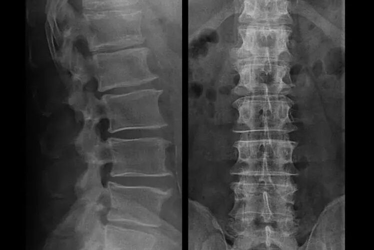 Osteoarthritis on X-ray