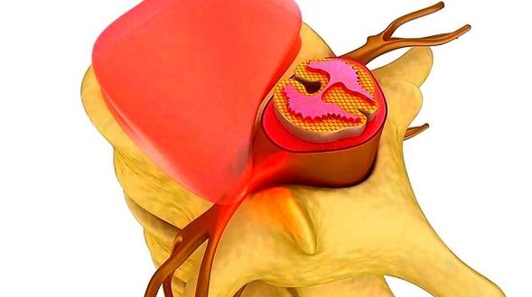Osteochondrosis of the chest spine